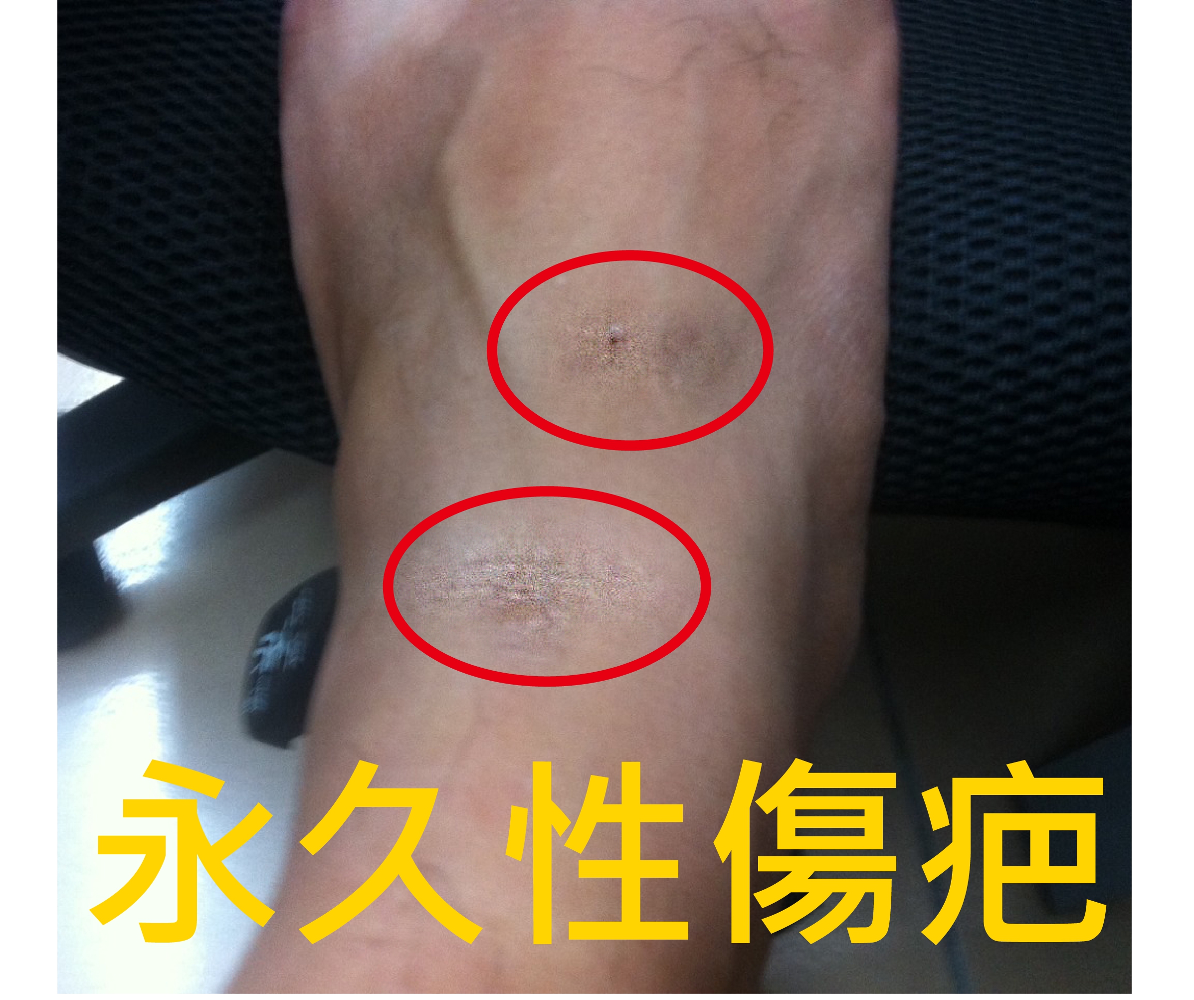 Scuba_JetFIn__噴射蛙鞋_傷疤 Scuba_JetFIn__噴射蛙鞋_傷疤